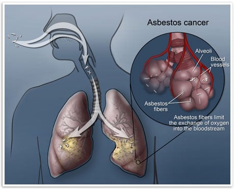 Asbestos Cancer  Treatment and Support for Pleural Cancer