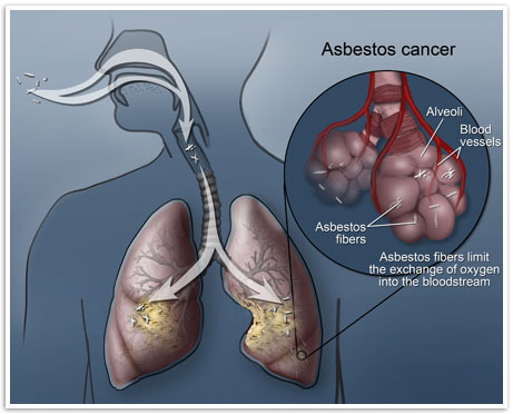 Asbestos Cancer