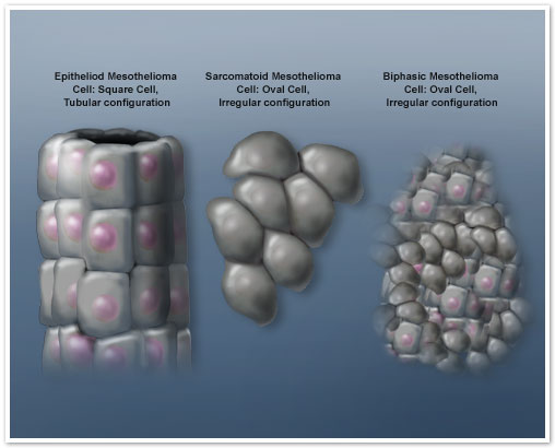 Mesothelioma Cell Types