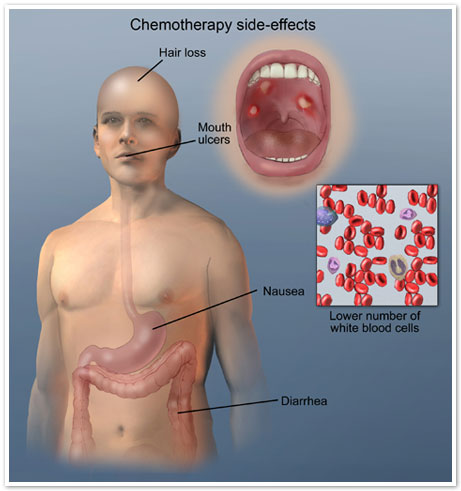 Treatment For Mouth Sores Due To Chemo