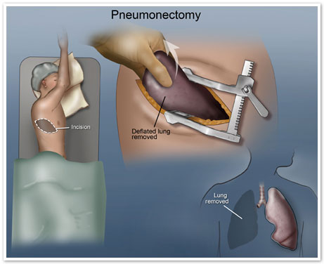 Mesothelioma Pneumonectomy