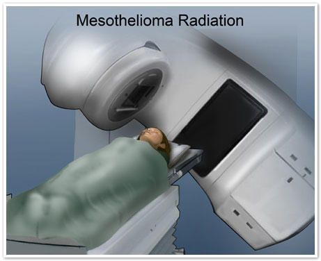 Standard Solutions for Mesothelioma