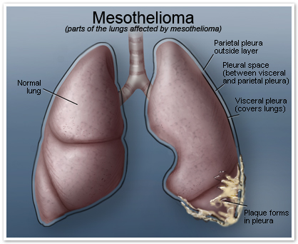 Mesothelioma Symptoms Treatment