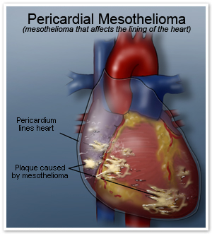 Pericardial Mesothelioma