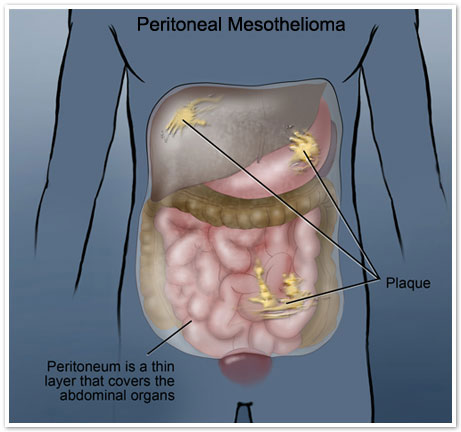 Peritoneal Mesothelioma