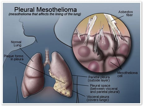 Pleural Mesothelioma. In most instances, pleural disease is not considered 