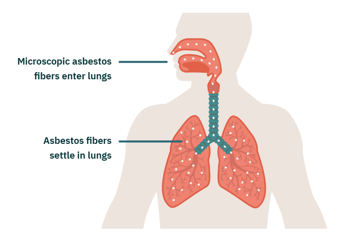 How Asbestos Causes Mesothelioma