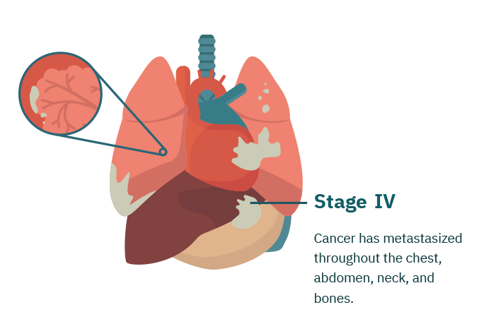 Stage 4 Mesothelioma  Life Expectancy  Treatment Options