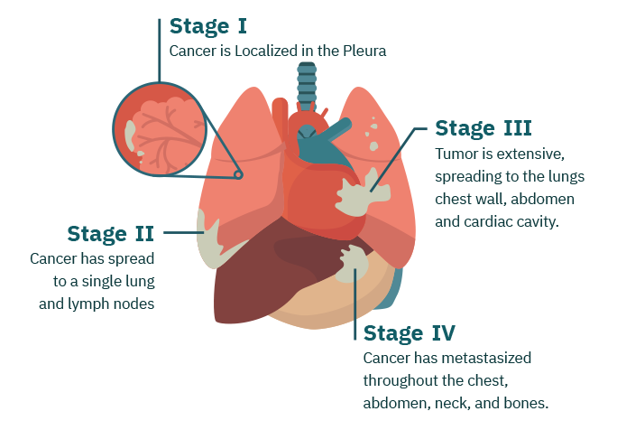 end of life care for mesothelioma