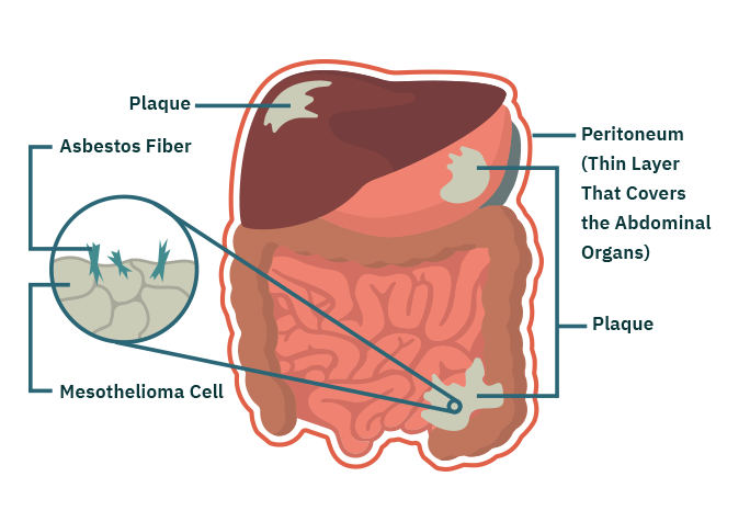 what-is-peritoneal-mesothelioma-cancer-canceroz