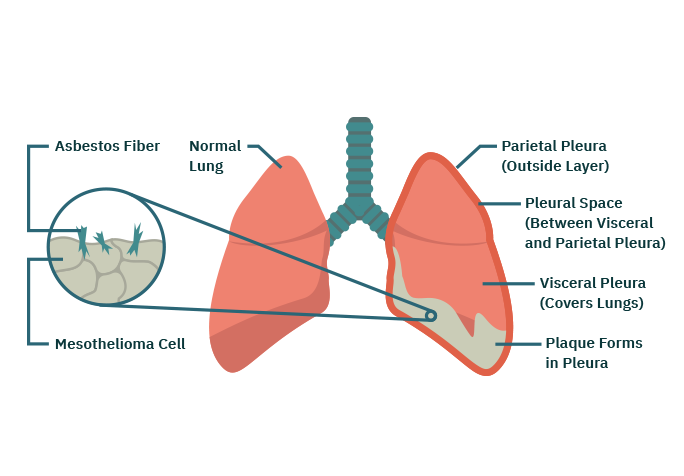 diagram_pleural diagram_pleural