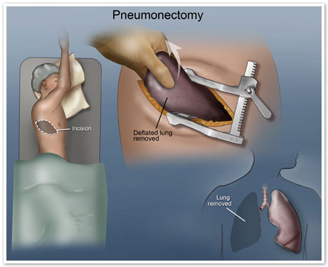 Mesothelioma Surgery Option