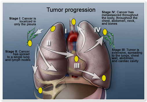 progression of mesothelioma symptoms