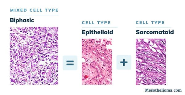 Image depicts how epithelioid and sarcomatoid cells combine to create biphasic mesothelioma.