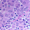 Epithelioid mesothelioma cells