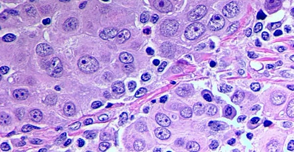 Epithelioid Mesothelioma Cells