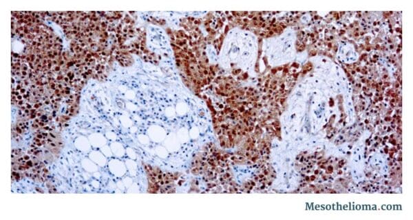 Epithelial cells with calretinin stain under a microscope