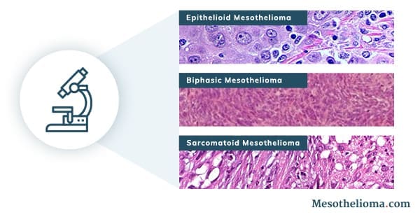 Mesothelioma pathology showing cell types under a microscope