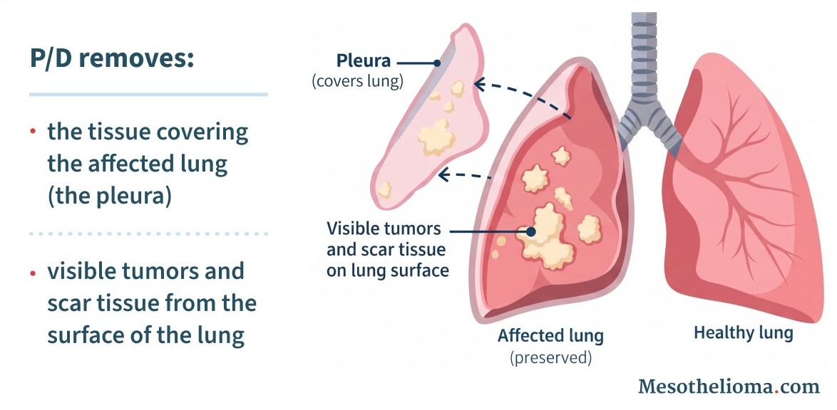 Illustration of pleurectomy/decortication (P/D), showing removal of the pleura, visible tumors and scar tissue from the surface of the lung while preserving the affected lung.