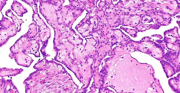 An image of rare mesothelioma cell types under a microscope.