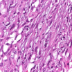 Sarcomatoid mesothelioma cells