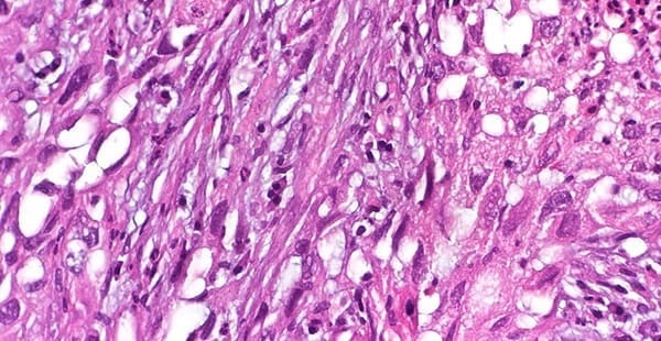 Sarcomatoid mesothelioma cells