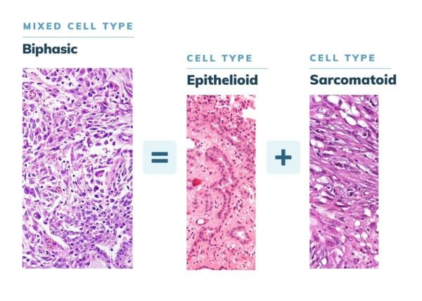 Image depicts how epithelioid and sarcomatoid cells combine to create biphasic mesothelioma.