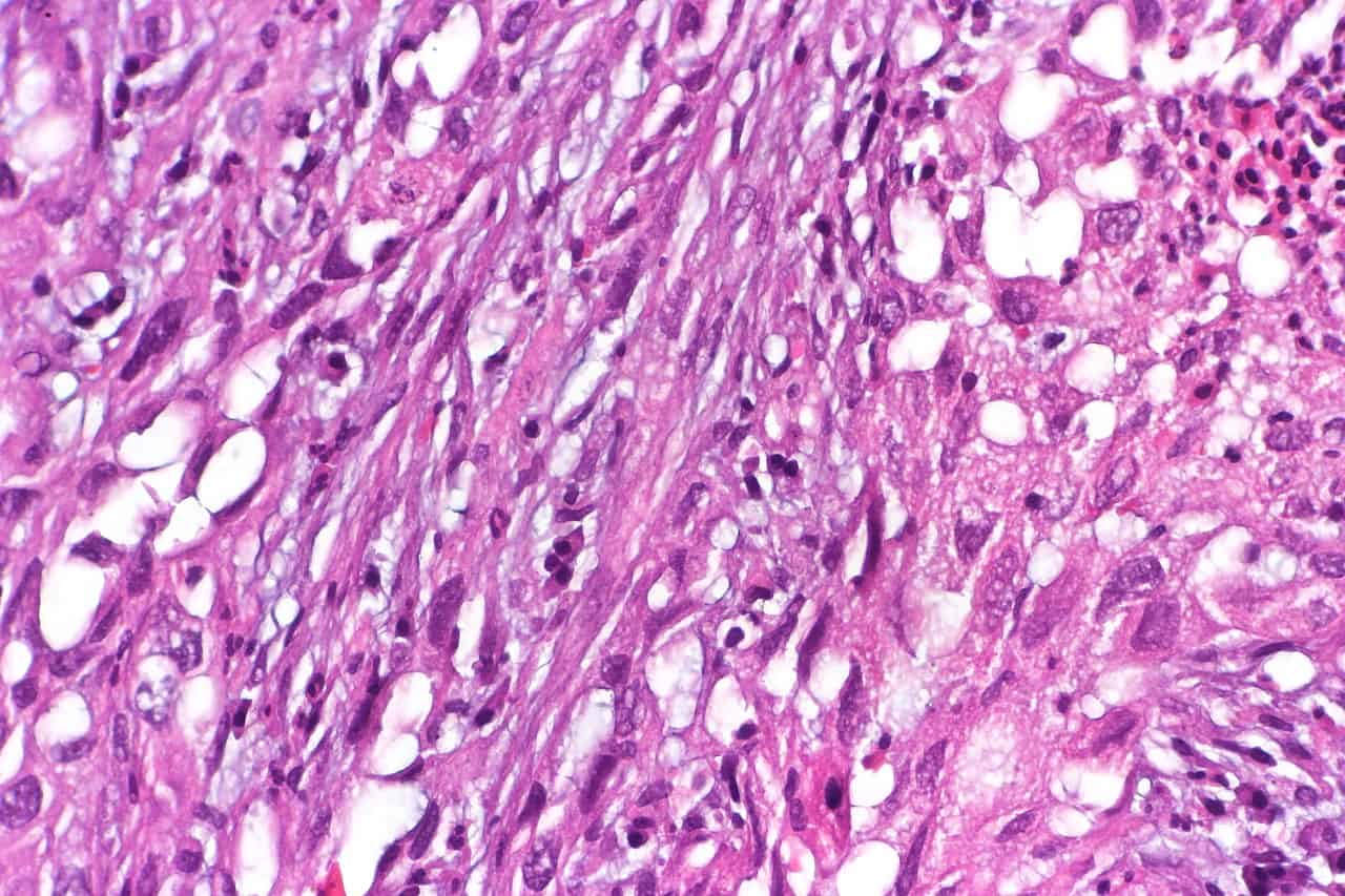 pleural mesothelioma history