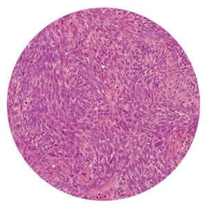 Biphasic mesothelioma cells