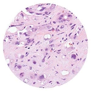 Epithelioid mesothelioma cells