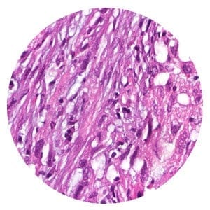 Sarcomatoid mesothelioma cells