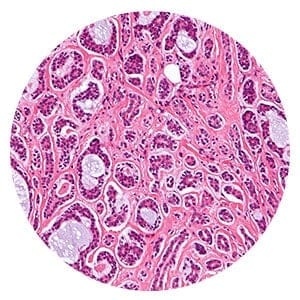Adenoid mesothelioma cells