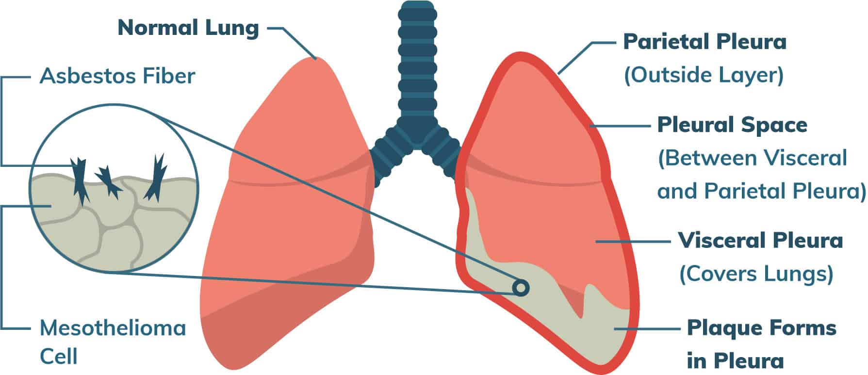 Mesothelioma Treatment Types and Guidelines