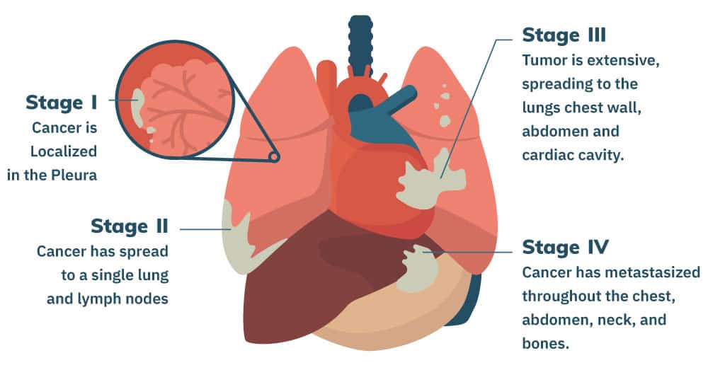 mesothelioma sarcomatoid research