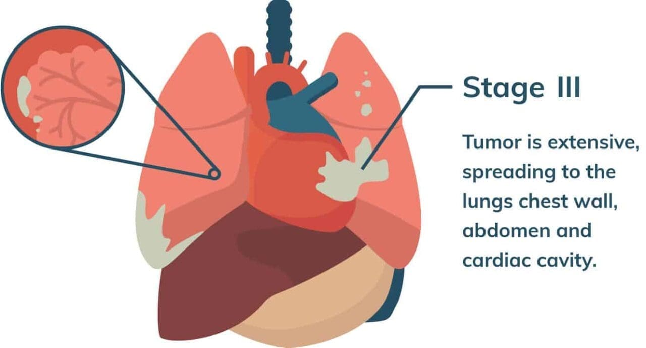 Mesothelioma pictures mesothelioma