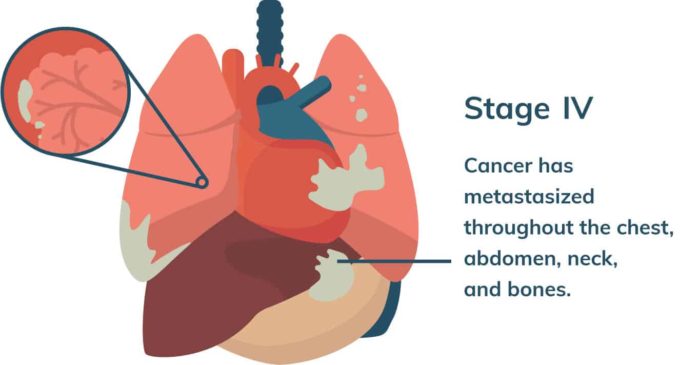 is copd easy to diagnose