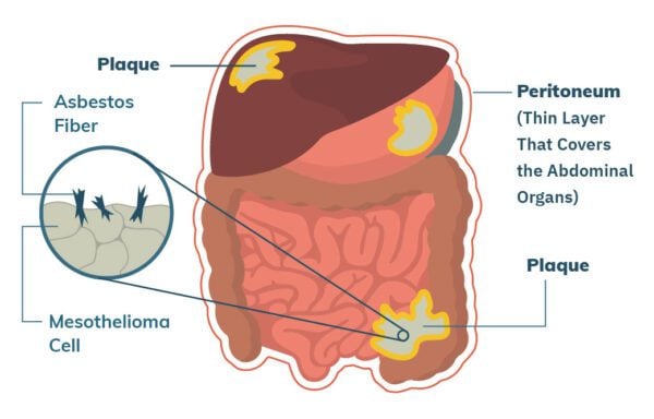 peritoneal-mesothelioma-treatment-prognosis-diagnosis