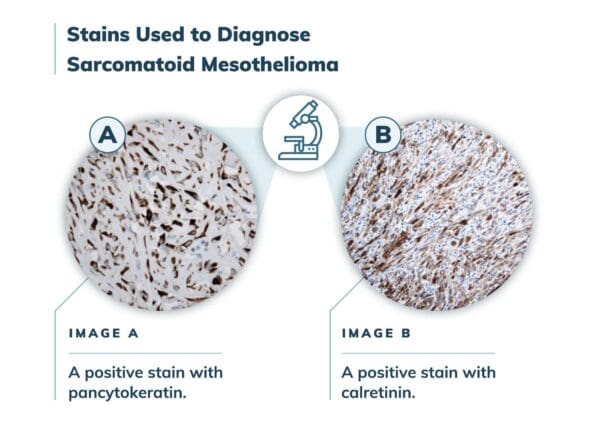 Sarcomatoid mesothelioma diagnosis