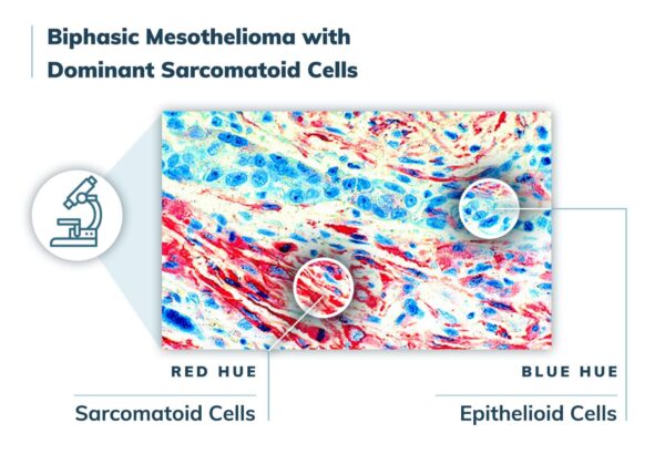 mesothelioma pathology outlines