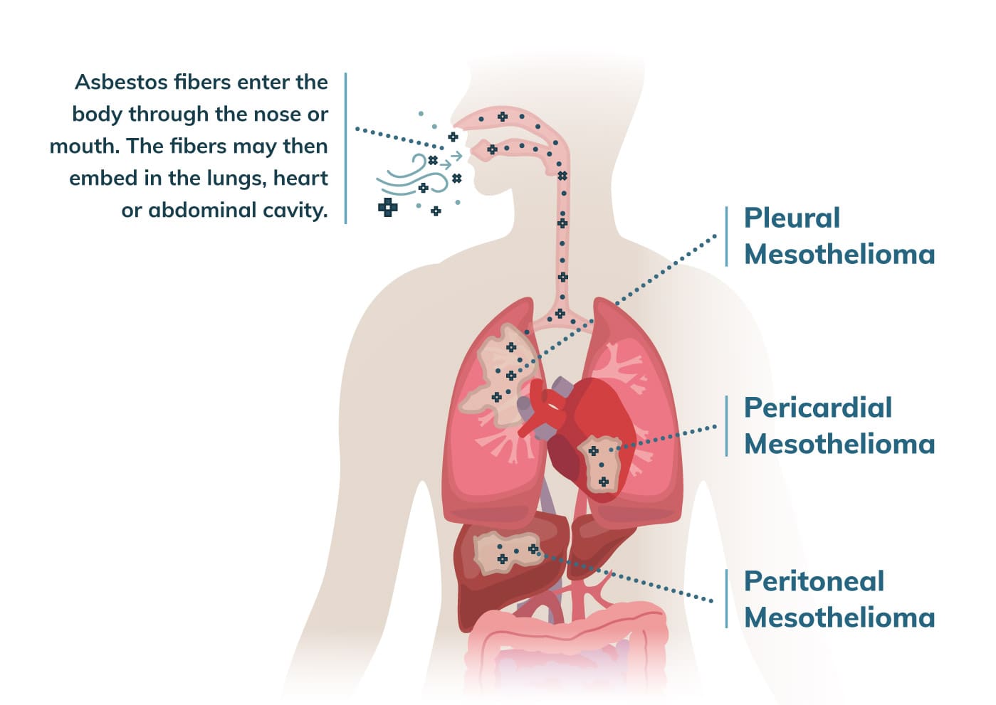 can testicular cancer cause stomach pain