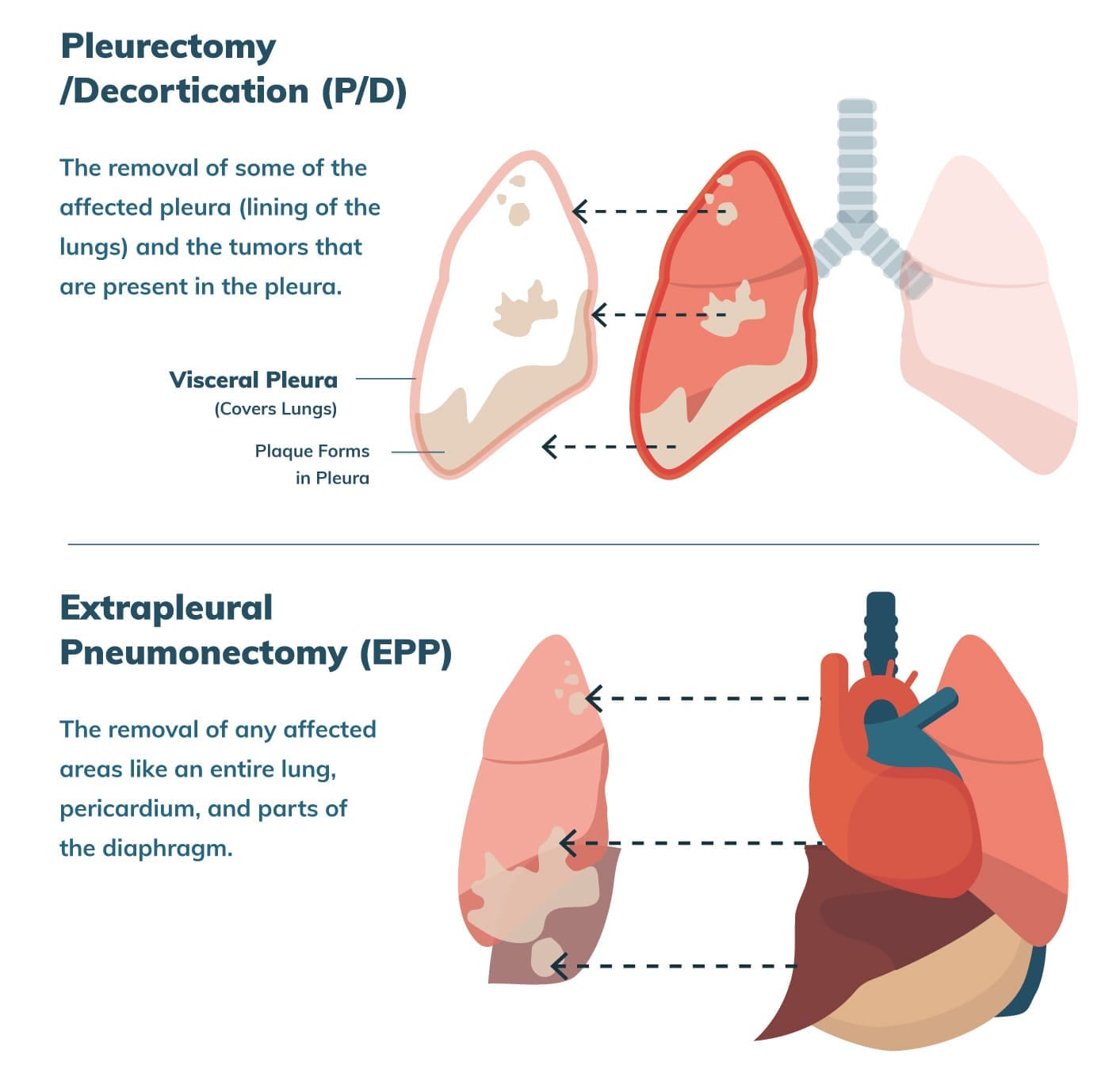 pipac mesothelioma