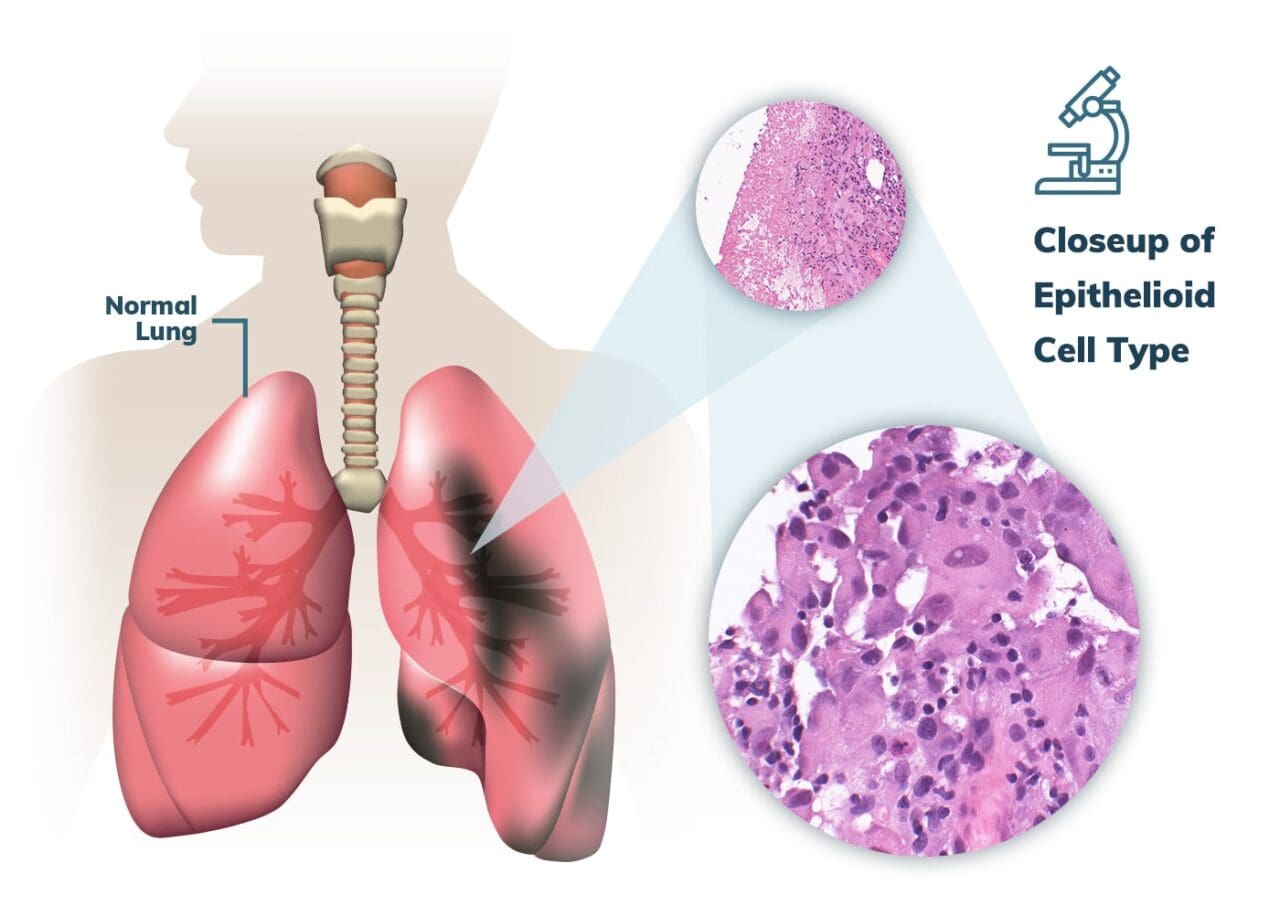 Pleural Mesothelioma 14.