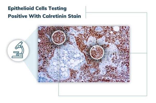Epithelioid cells with calretinin stain