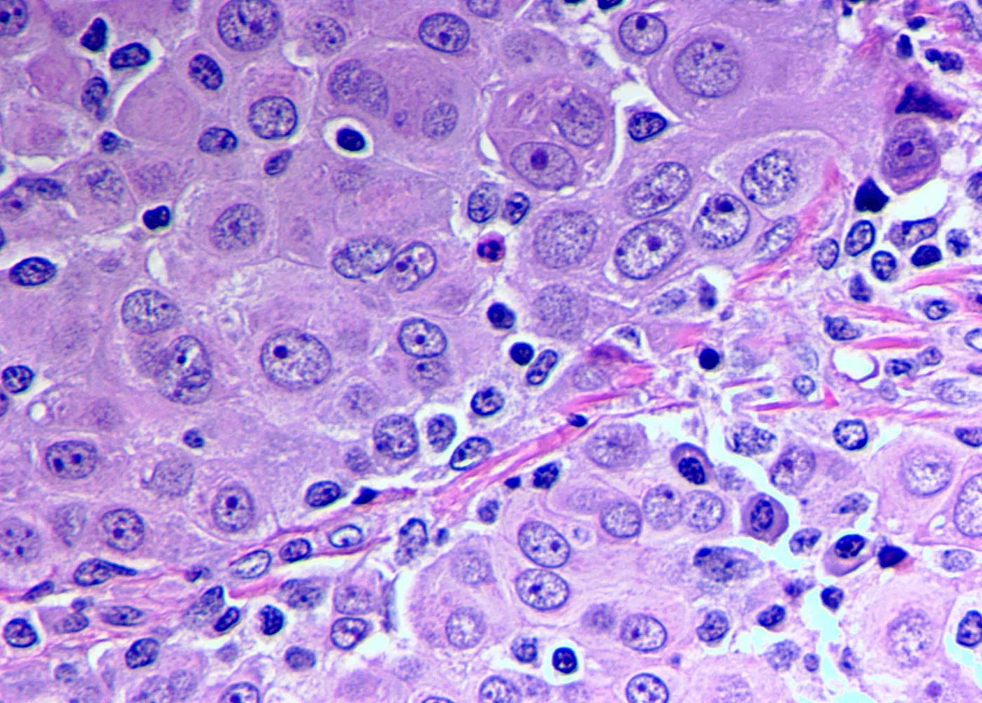 Epithelioid Mesothelioma Cells