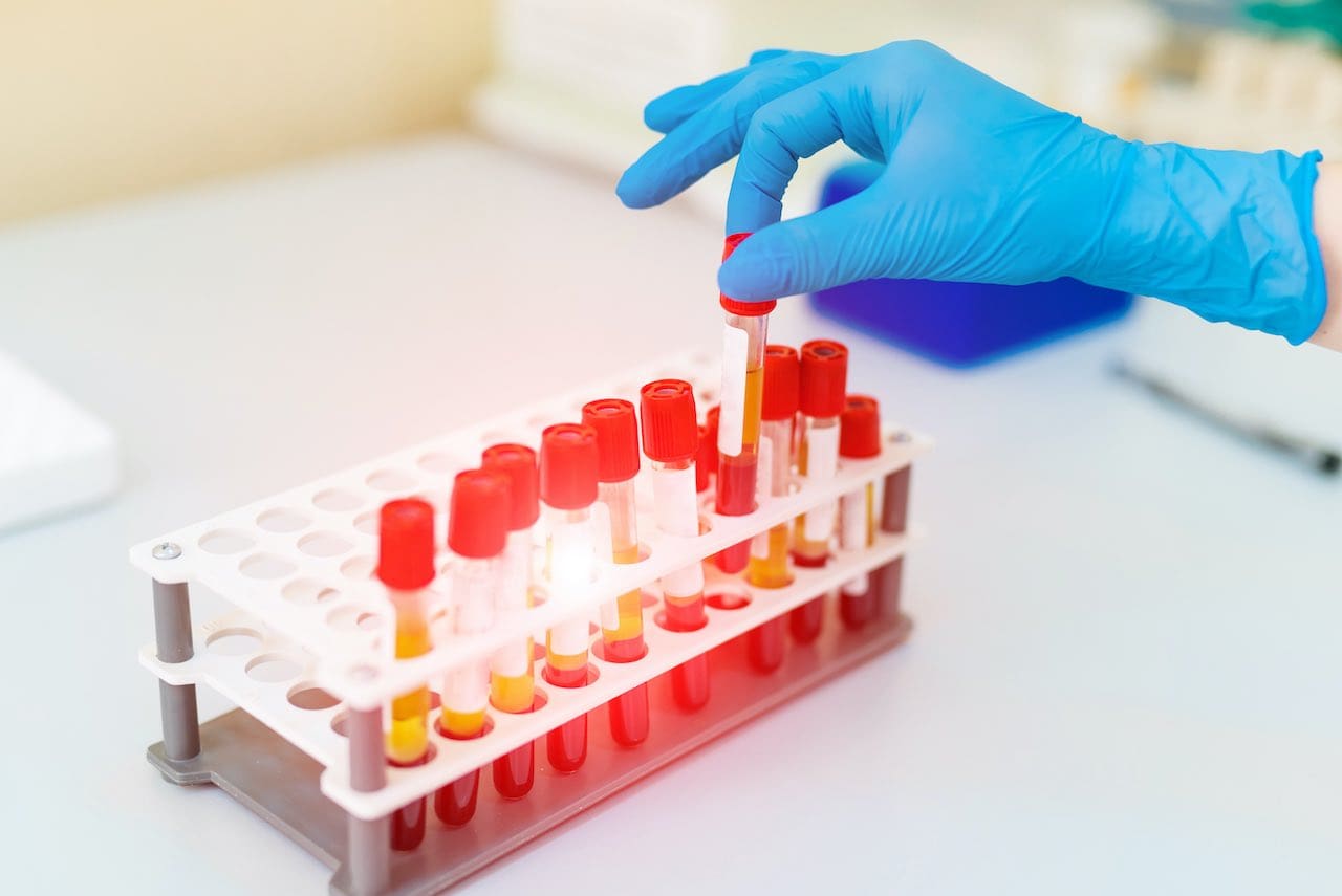 GATA3 Mesothelioma Biomarker