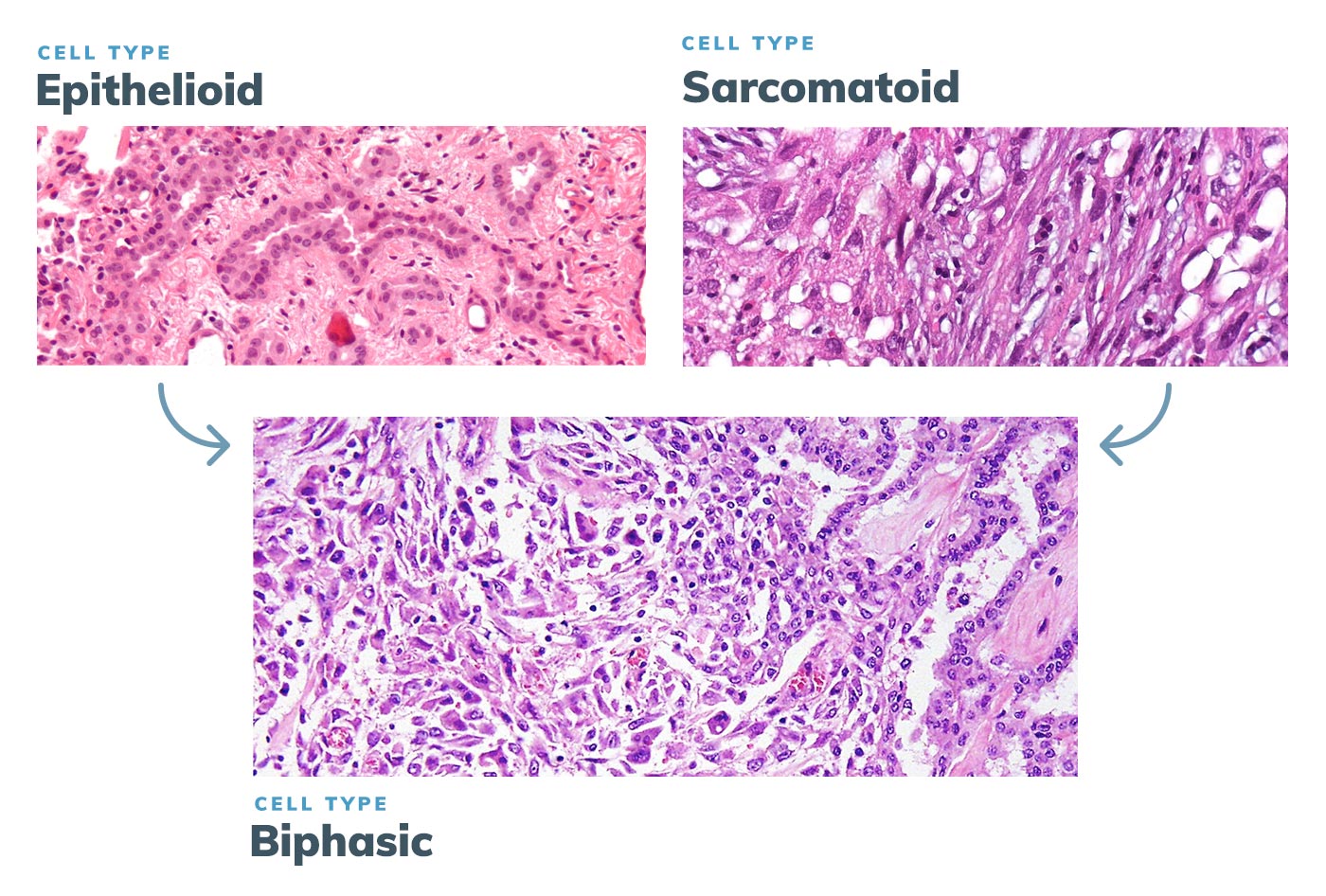 Biphasic mesothelioma cell type prognosis treatment