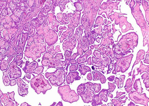 Papillary mesothelioma cells in histology outline