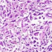Biphasic mesothelioma cells