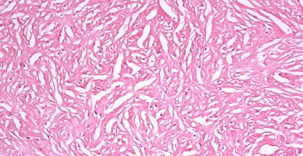 Desmoplastic Cells Under a Microscope