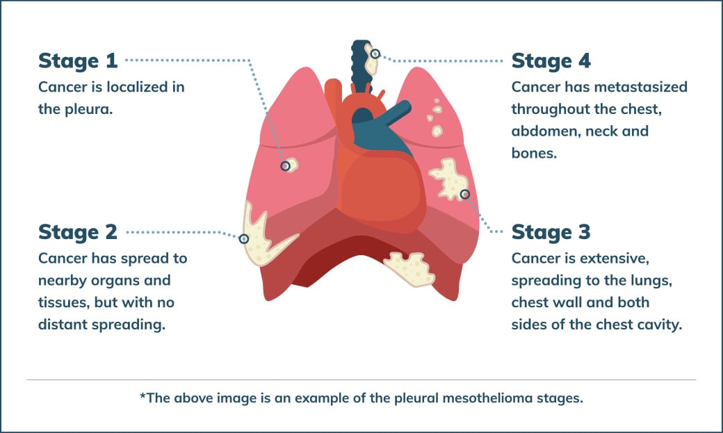 An illustration of the 4 stages of mesothelioma